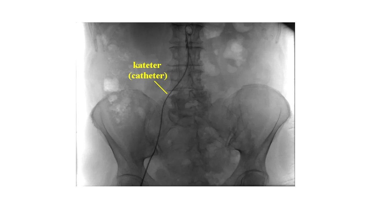 Imagem de angiografia com cateter em procedimento de hemodinâmica
